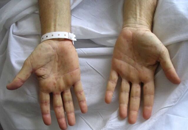 syphilis in the hands as a cause of pathological discharge from the penis